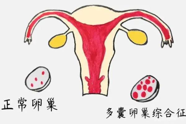 多囊能不能促排 多囊卵巢促排卵怀孕率高吗