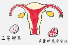 多囊卵巢可以怀孕吗？多囊卵巢怀孕后易流产吗？