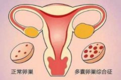 多囊卵巢综合征严重吗？多囊样改变什么意思？