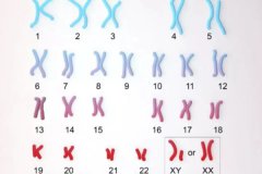 染色体能查出侏儒症吗？染色体多久出结果？