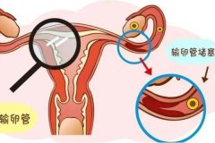 输卵管阻塞的症状有哪些？输卵管堵塞会排卵吗？