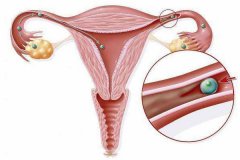 输卵管比较长会影响生育吗？会引起宫外孕吗？