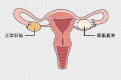 卵巢囊肿有什么症状？是什么原因引起的？