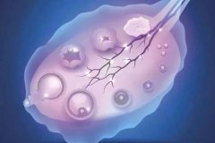 多囊卵巢综合征会排卵吗?多囊卵巢综合征的卵泡数量?